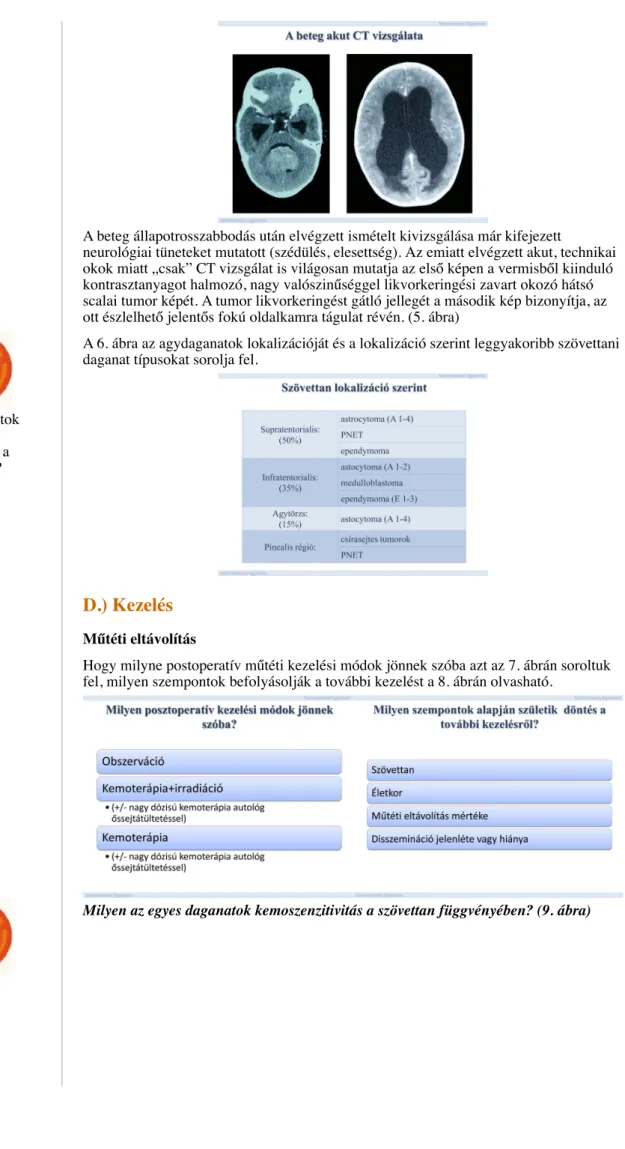 A 6. ábra az agydaganatok lokalizációját és a lokalizáció szerint leggyakoribb szövettani daganat típusokat sorolja fel.