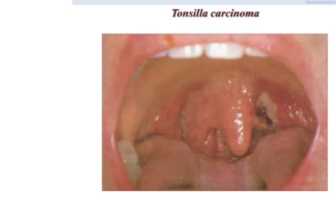 Az alábbi esetbemutatásban a tonsilla carcinomáról (1. ábra) lesz szó, mely a szájüreg-garat carcinomáinak 5%-át alkotja.