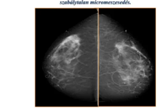 3. ábra: A mammographiás felvételen jól látszik a jobb emlő külső-alsó negyedében megjelenő szabálytalan micromeszesedés.