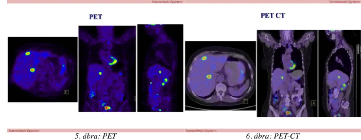 5. ábra: PET 6. ábra: PET-CT