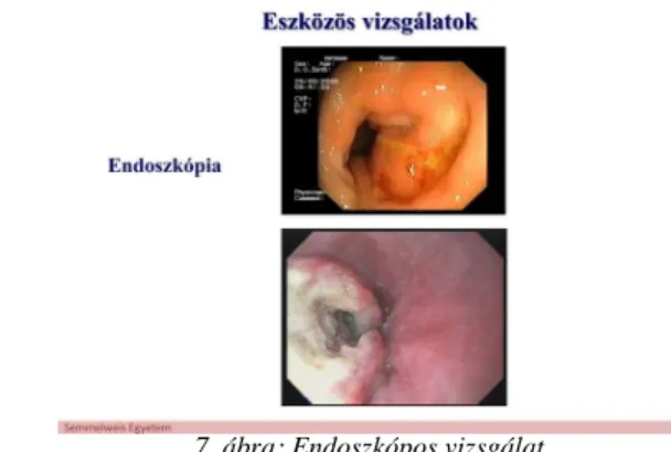 7. ábra: Endoszkópos vizsgálat