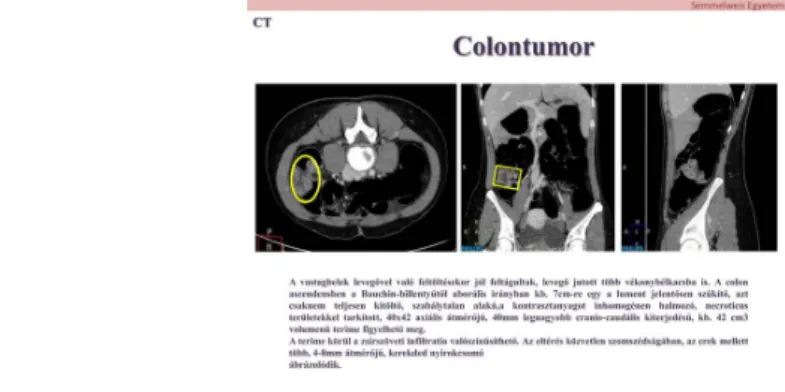 5. ábra: 33 éves beteg, alhasi panaszokkal került vizsgálatra, a fizikális vizsgálat során jobb alhasi terimét tapintottak, mely miatt natív + kontrasztos CT vizsgálat történt, amely colon tumor fennállását mutatta.