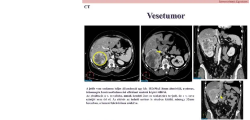 12. ábra: 58 éves nőbeteg, haematuria kivizsgálása kapcsán történt natív + kontrasztos CT vizsgálat mely jobb oldali vesetumort igazolt.