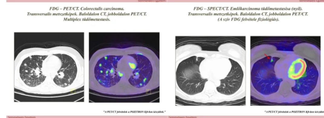Az alábbi két ábrán (10. és 11. ábra) egy colorectális carcinomás beteg multiplex tüdőmetasztázisait és emlőcarcinómás beteg szoliter tüdőmetasztázisa látható.