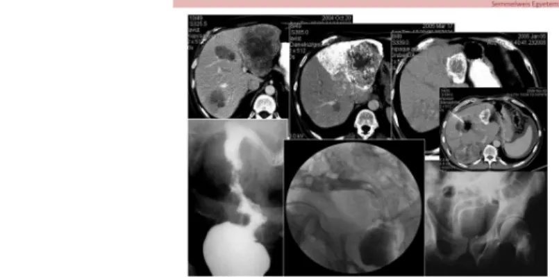 5. ábra: A képsorozaton lent, balról jobbra az acut elzáródással jelentkező primer tumor stentelését látjuk