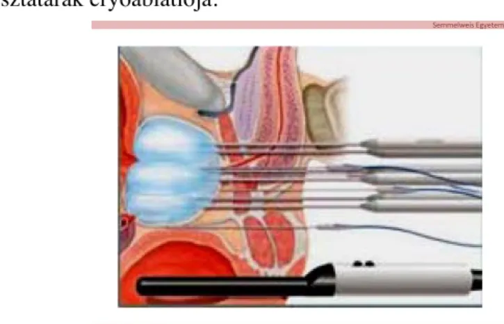 3. ábra: Transrectális UH vezérelt, több elektródával szinkronban végzett prosztata cryoablatio