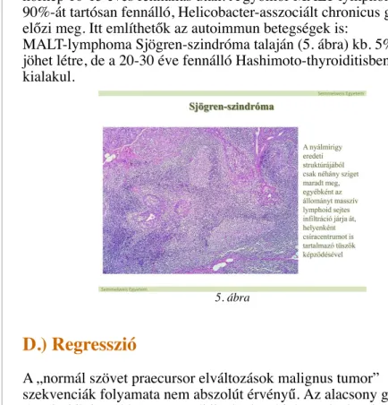 MALT-lymphoma Sjögren-szindróma talaján (5. ábra) kb. 5%-ban jöhet létre, de a 20-30 éve fennálló Hashimoto-thyroiditisben is kialakul.