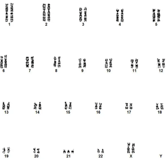 2. ábra A 21-es kromoszóma triszómiájainvazív mintavételezés után végzett  citogenetikai vizsgálattal
