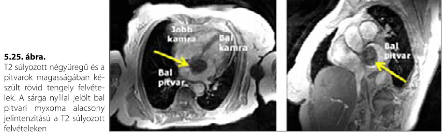 5.5. táblázat. Szívtumorok MRI jellemzői 