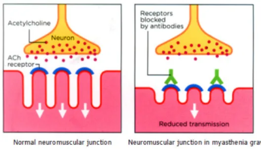 3. és 4. ábra: A neuromuszkuláris junkció:normál  és myasthenia gravisban 