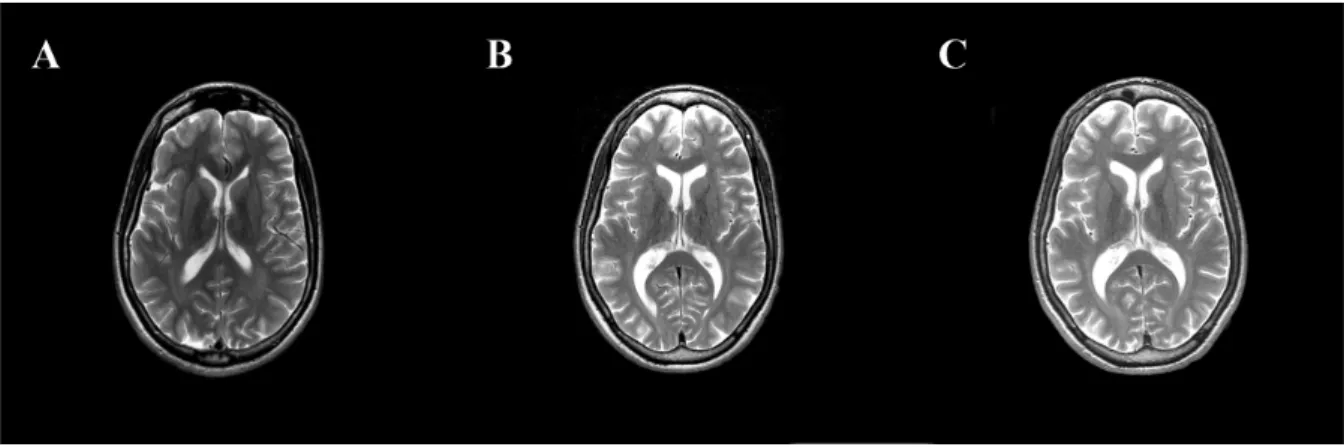 11. ábra. 17 (A), 20,5 (B) és 23 (C) éves korban felvett axiális síkú T2 súlyozott MRI felvételek