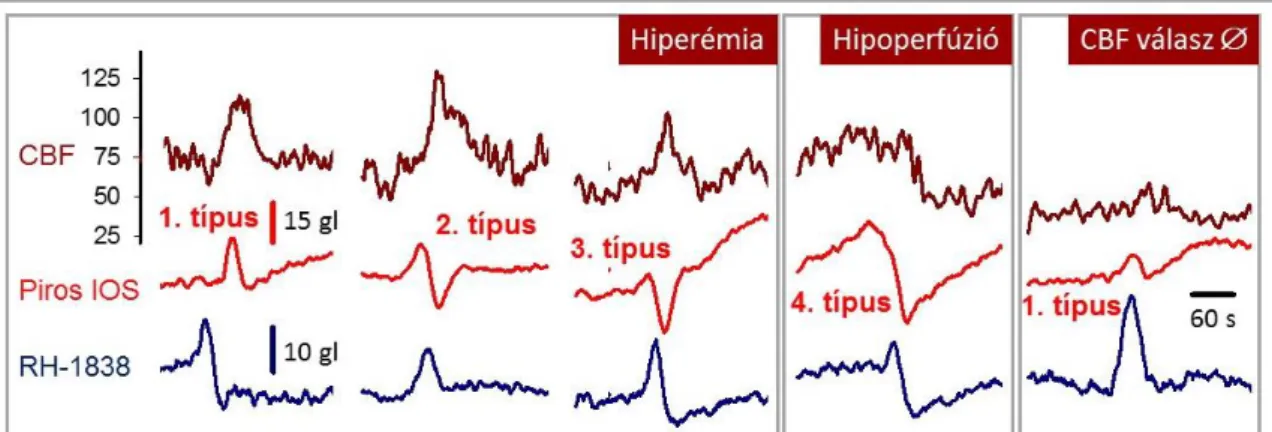 8 perc múlva) sem is rendeződött ( 5.2.7. ábra ). A legelfogadottabb nézet szerint, a megfigyelthez  hasonló lefutású terjedő iszkémia a sérült agykéregben úgy jön létre, hogy a kezdeti hipoperfúzió  meghatározóvá válik, elfedve a hiperémiás fázist