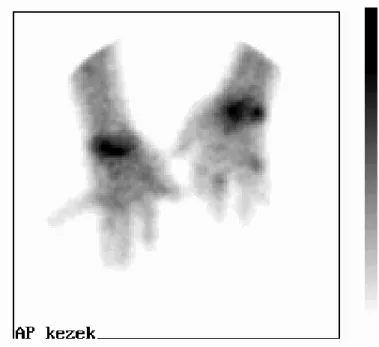 IV.1. Ábra. AP felvétel: Reumatoid arthritises beteg Tc99m HMPAO jelzett leukocyta ízületi  szcintigráfiás vizsgálata (csuklók + kezek)