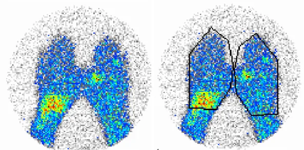 IV.6. Ábra A kezek  99mTc anti-granulocyta szcintigráfiás képe, a jobb oldali képen a kezek köré  vont ROI-kkal: a bal csukló és a job oldali II