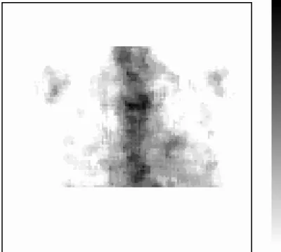 V.2. Ábra. Myocardium Ga-67 szcintigráfia. A mellkas anterior nézetű Metz-szűrt képén a szív  vetületében kifejezett radiofarmakon halmozás figyelhető meg