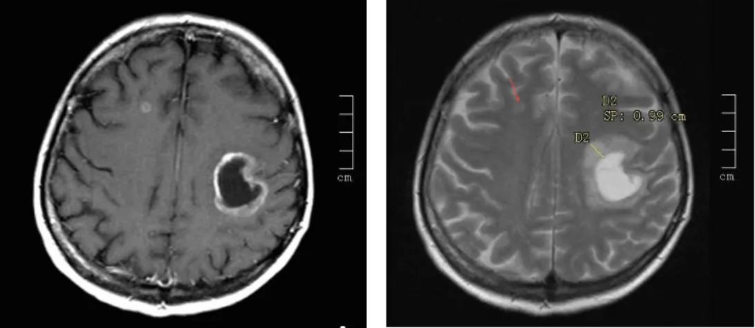 9. ábra. Koponya MRI felvétel: Tüdőrák okozta multiplex agyi metasztázis 