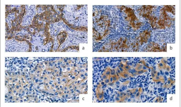 20. ábra. EGFR és ErbB2 protein expresszió vizsgálata tüdő adenocarcinoma mintákban                                                                                  (a: EGFR, x200, b: pEGFR, x200, c: ErbB2, x400, d: pErbB2, x400)