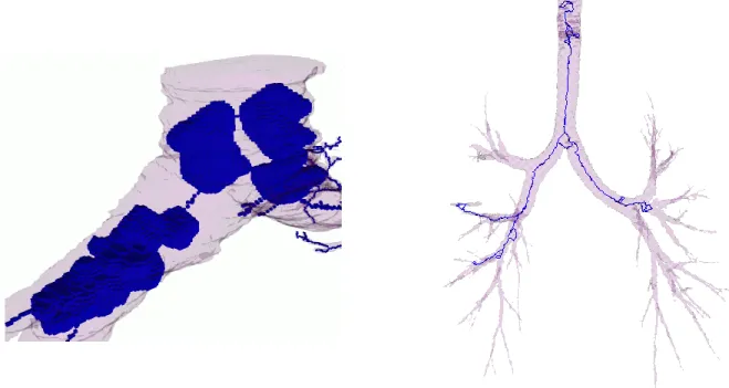 2. ábra. Hibásan szegmentált (CT-vizsgálatokból származó) rózsaszín légútfák és a rájuk  vetített kék topológiai magok