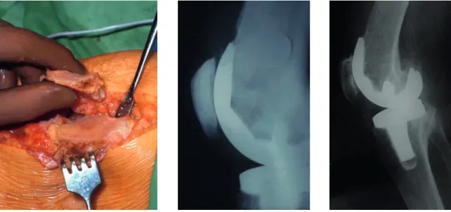 16. ábra:  Patella spongializáció műtéti képe és posztoperatív kontroll röntgenfelvétele 