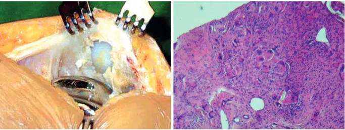 18. ábra:  Változatlan állapotban hagyott patella szövettani teljes metszete (Giemsa 10x) (A)  Egy másik eset súlyosan arthrotikus makroszkópos- (B), valamint röntgenfelvétele 