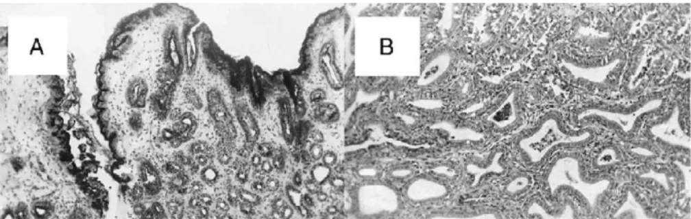 Fig. 3 Histology of gastric mucosa at 6 and 12 months postoperatively. A, Atrophy: tortuous, irregular, atrophic narrowed glands in the loose stroma of the epithelium (PAS; original magnification 100)