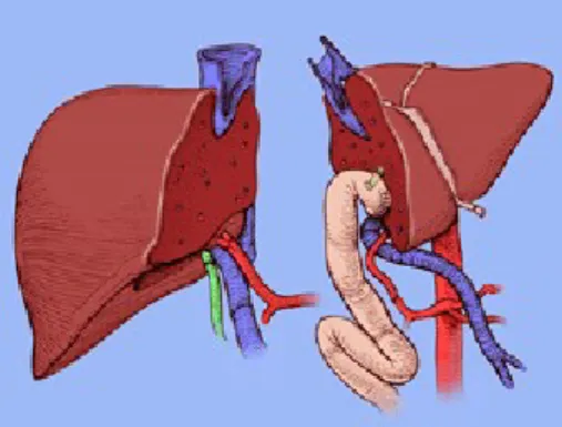 1. ábra: májtranszplantáció – artériás anasztomózisok,  forrás: X. Rogiers és mtsai Split Liver  Transplantation, Springer, 2002 