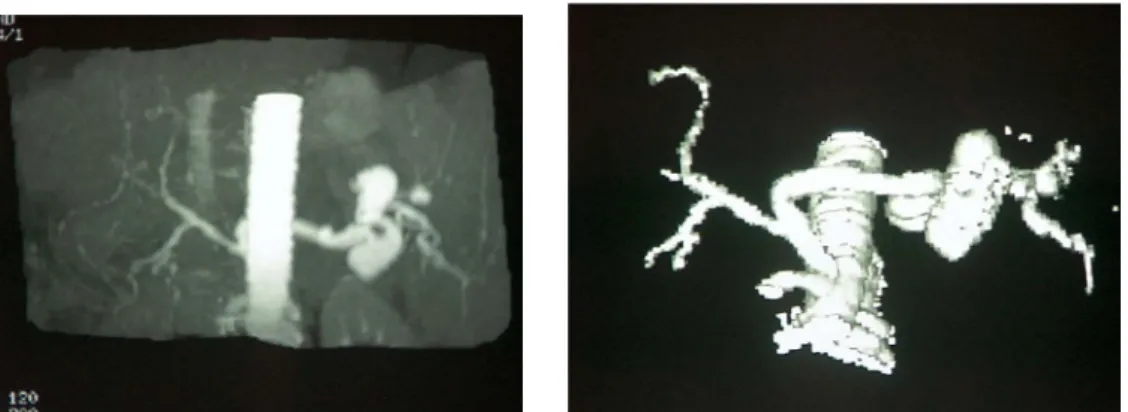 1. ábra. a: LAA CT Angiographiája; b: 3D kép 