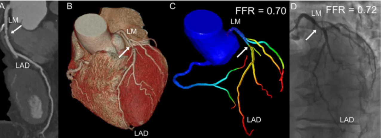 Figure 19 | A representative example of the on-site FFR-CT simulation. Coronary CTA examination showed  a partially calcified plaque on the proximal LAD causing moderate stenosis (50% to 69%) (Panels A and B)