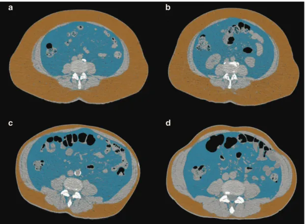Figure 22 | Abdominal subcutaneous and visceral adipose tissue compartments in monozygotic twin pairs