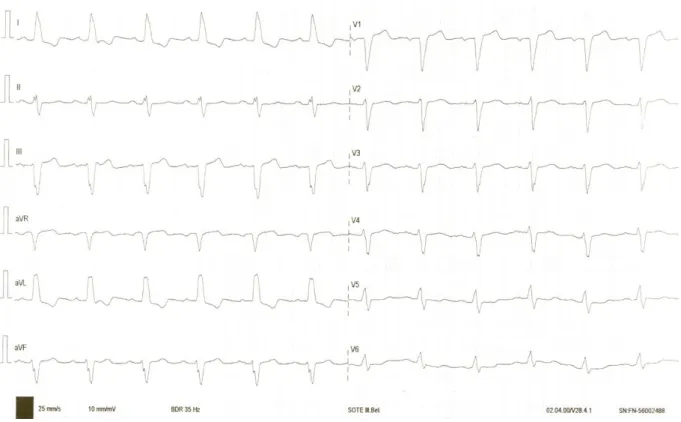 11. ábra. A frontális és horizontális síkú eredő ST vektorok hagyományos EKG  módszerrel történő becslése