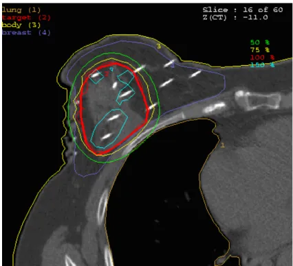        2. ábra: Eml ő t ű zdelés konformális dóziseloszlása egy CT szeleten 