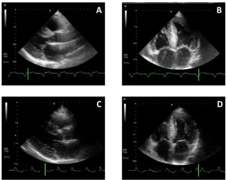 4. ábra. A transthyretin amyloidózisban szenvedő betegek transthoracalis echocardiographiás felvétele,  parasternális hossztengelyi (A panel: ’A’ beteg; C panel: ’B’ beteg) és csúcsi négy üregi (B panel: ’A’ beteg, 