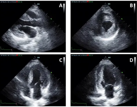 6. ábra. A beteg transthoracalis echocardiographiás felvételei, non-obstruktív hypertrophiás  cardiomyopathia képével, tágabb bal pitvarral, kifejezett koncentrikus bal és jobb kamra hypertrophiával