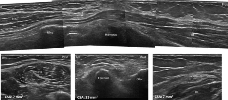 5. ábra. Idiopathiás cubitalis alagút syndroma. A felső kép hosszmetszetben, az  alsó képek keresztmetszetben mutatják az ideget a könyök alatt (bal alsó kép),  az epicondylus magasságában (alsó középső kép) és a könyök felett (jobb alsó  kép)