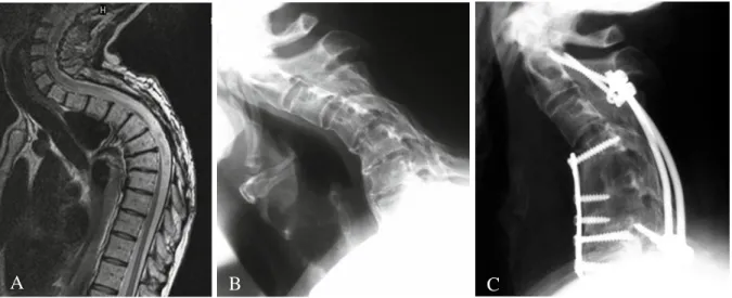 1. ábra. Szagittális T2 súlyozott MR képeken a cervico-thoracalis régióban (A)   és az oldalirányú RTG képeken a nyaki gerinc területén (B)  posztlaminektómiás 