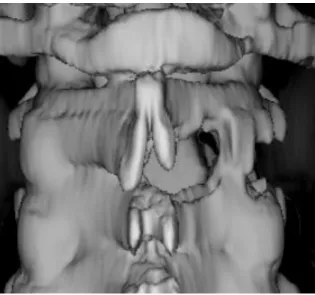 22. ábra. Hemi-semi laminectomiával kombinált „nyitott csatorna” technika 3D  CT felvételen