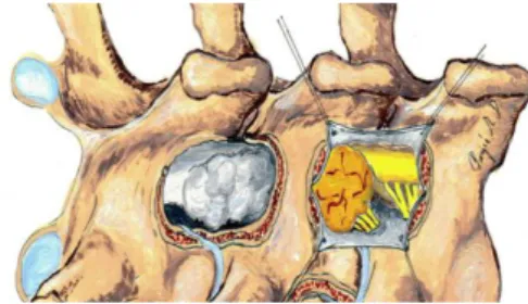 3. ábra. A sematikus ábra a thoracalis gerincszakaszon a canalis  spinalisban elhelyezkedő tumort és a hemi-semi laminectomiát (2x) 