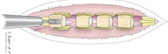 7. ábra.  Az illusztráció a split laminotomiát ábrázolja, valamint a  szétválasztott ívek közé helyezett saját csípőcsont graftokat, amelyekkel a 