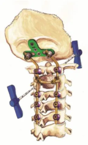 11. ábra.  A sematikus rajz a transzorális és a transzpediculáris  vertebroplasztikát lehetővé tévő injectáló eszköz elhelyezkedését mutatja, 
