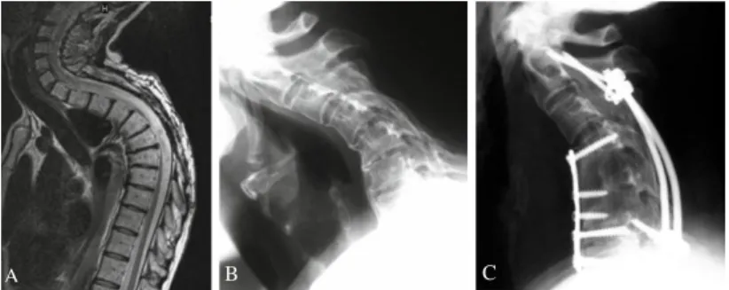 1. ábra. Szagittális T2 súlyozott MR képeken a cervico-thoracalis  régióban (A) és az oldalirányú RTG képeken a nyaki gerinc területén (B)  