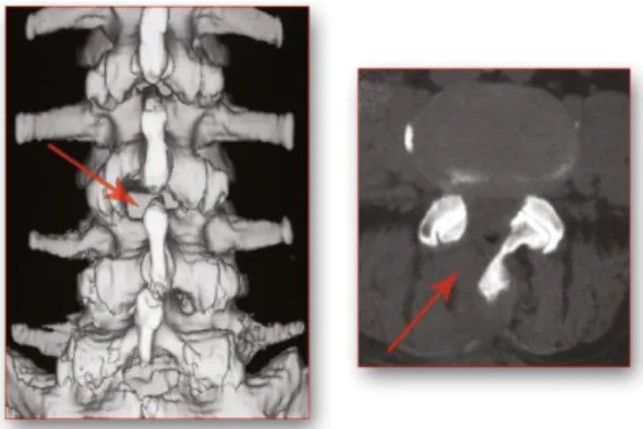 2. ábra. Posztoperatív 3D CT rekonstrukció (bal) és axiális CT (jobb)  felvételen látható a féloldali interlamináris „ablak” (nyíl) az ágyéki 