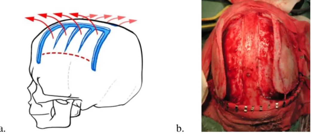 3. ábra. Biparietalis decompressio illusztrációja (a.), illetve műtéti képe (b.). 