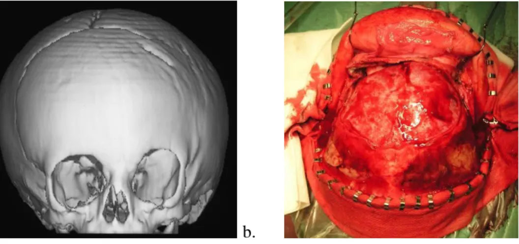 8. ábra. Bal oldali coronavarrat izolált synostosisának 3D  CT rekonstrukciója (a.), illetve az  orbitatető előrehelyezésének műtéti képe (b.)