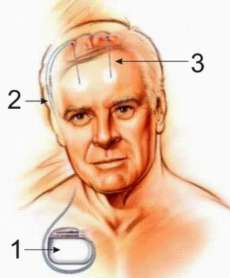 3.5. ábra. A mély agyi stimulációs rendszer három fő komponense: 1. impulzus generátor, 2