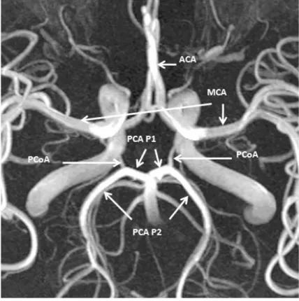 3. ábra Az intrakraniális nagyerek MR angiográfiás képe. Jól látható, hogy a PCA P1-es  szakasza előre és lateralis, P2 szakasza hátra és lateralis, majd hátra és mediális irányba halad