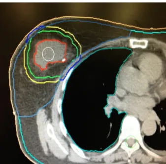 12. ábra: Céltérfogatok CT alapú meghatározása 3D-KRT-vel és IG-IMRT-vel végzett  parciális emlőbesugárzáshoz 