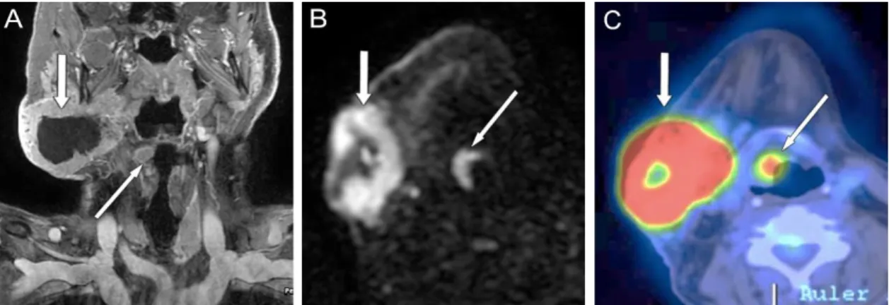 7. ábra Jobb oldali nyaki nyirokcsomó metasztázis, képalkotókkal felfedezett primer tumor  a nyelvgyök jobb oldalán (nyíl) 