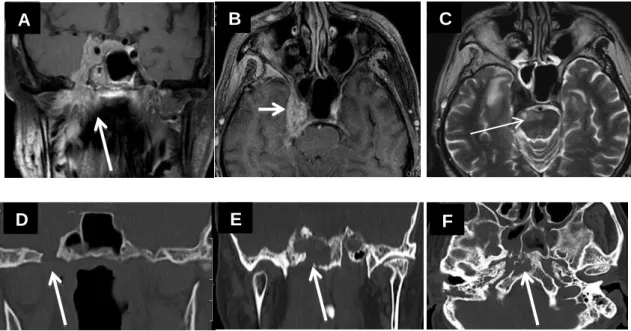 25. ábra Intracraniális, perineurális terjedés a nervus trigeminus mentén, T4 stádium  Felső MRI képek, A