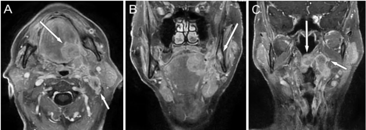 35. ábra Mesopharynx carcinoma nyelvgyökben, tonsilla palatinában, T4aN2b stádium  3T MR képek, CE-T1-FS mérések