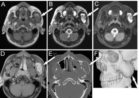 2. ábra Aneurysmás csont cysta. Az MRI szerepe a lágyrész elváltozások vizsgálatában, a  CT szerepe a csontstruktúra kiegészítő megítélésében van 